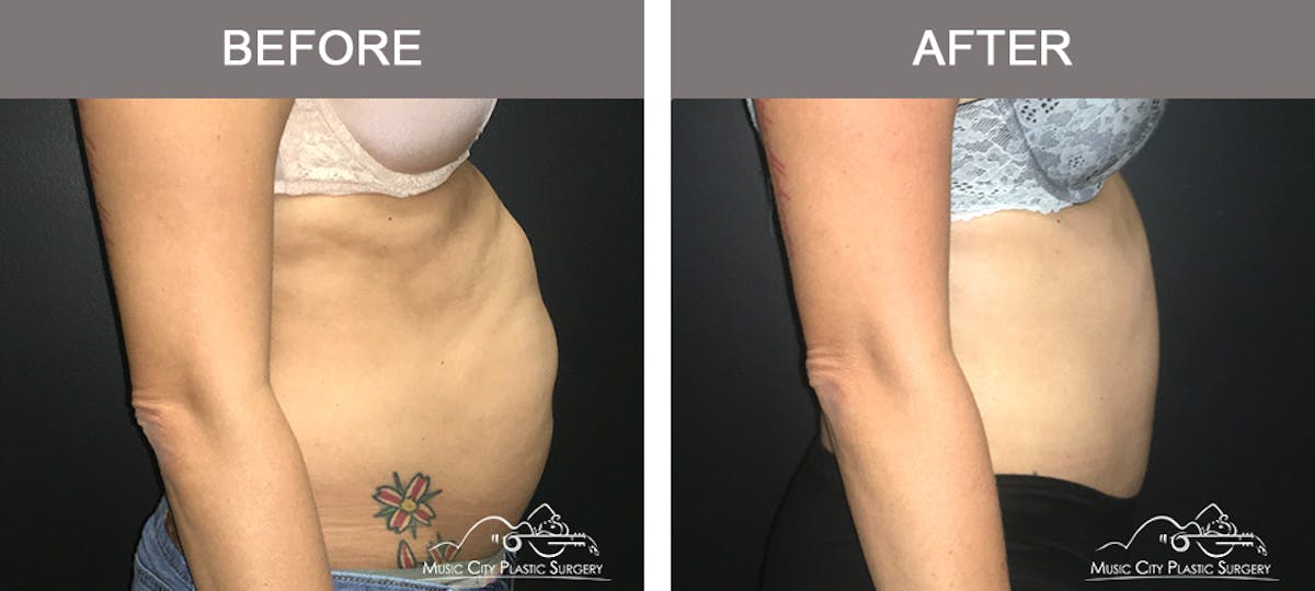 Abdominoplasty Before & After Gallery - Patient 134343 - Image 3