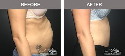 Abdominoplasty Before & After Gallery - Patient 134343 - Image 3