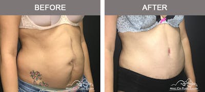 Abdominoplasty Before & After Gallery - Patient 134343 - Image 2