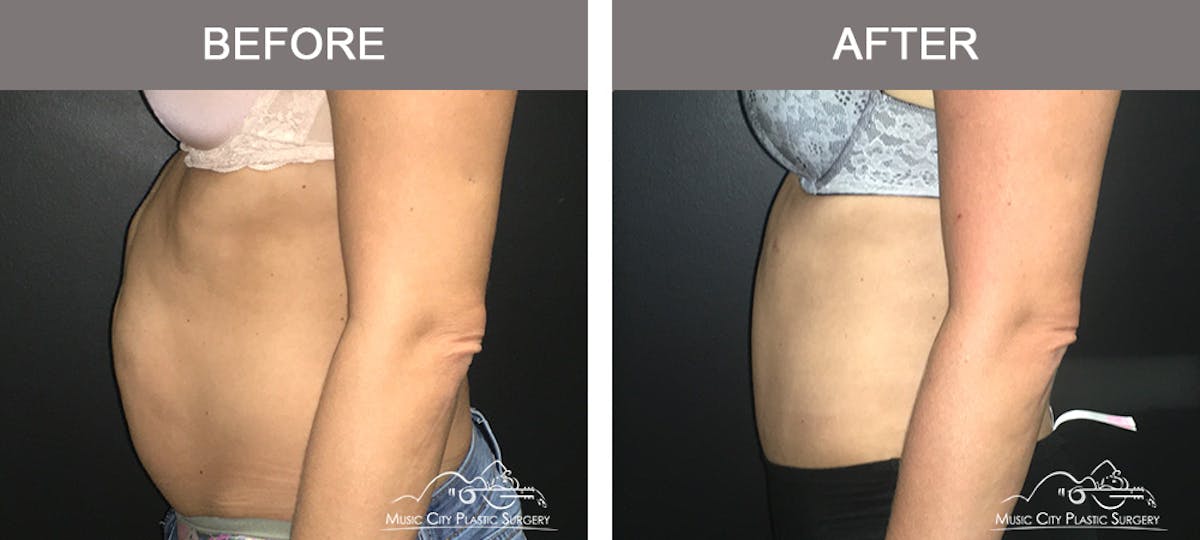 Abdominoplasty Before & After Gallery - Patient 134343 - Image 5