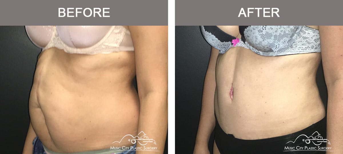 Abdominoplasty Before & After Gallery - Patient 134343 - Image 4