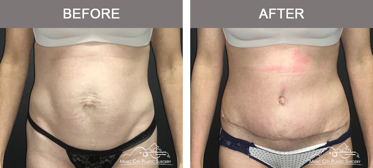 Abdominoplasty Before & After Gallery - Patient 174413 - Image 1