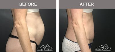 Abdominoplasty Before & After Gallery - Patient 174413 - Image 3