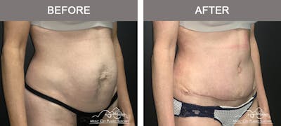 Abdominoplasty Before & After Gallery - Patient 174413 - Image 2