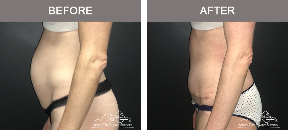 Abdominoplasty Before & After Gallery - Patient 174413 - Image 5