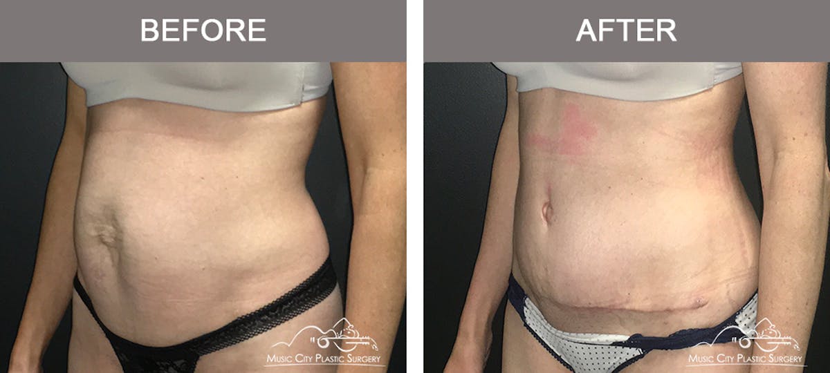 Abdominoplasty Before & After Gallery - Patient 174413 - Image 4