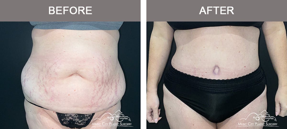 Abdominoplasty Before & After Gallery - Patient 505183 - Image 1