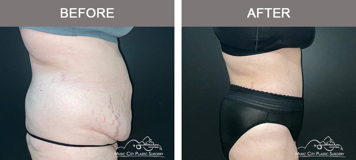 Abdominoplasty Before & After Gallery - Patient 505183 - Image 3