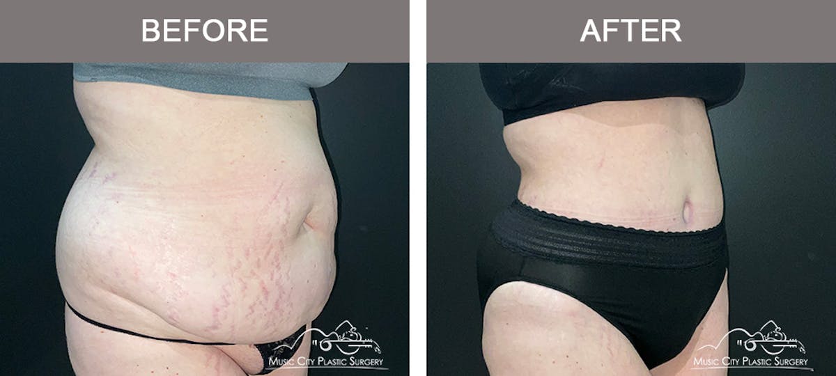 Abdominoplasty Before & After Gallery - Patient 505183 - Image 2