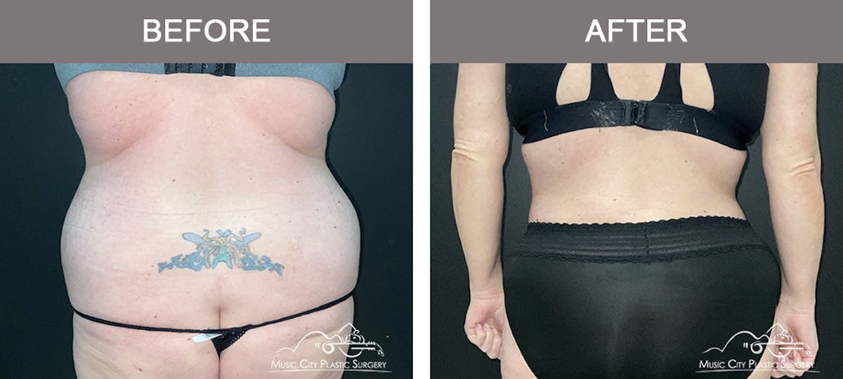 Abdominoplasty Before & After Gallery - Patient 505183 - Image 6