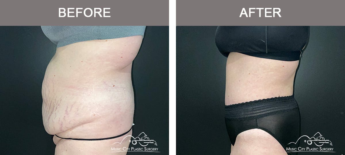 Abdominoplasty Before & After Gallery - Patient 505183 - Image 5