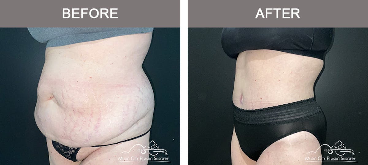 Abdominoplasty Before & After Gallery - Patient 505183 - Image 4