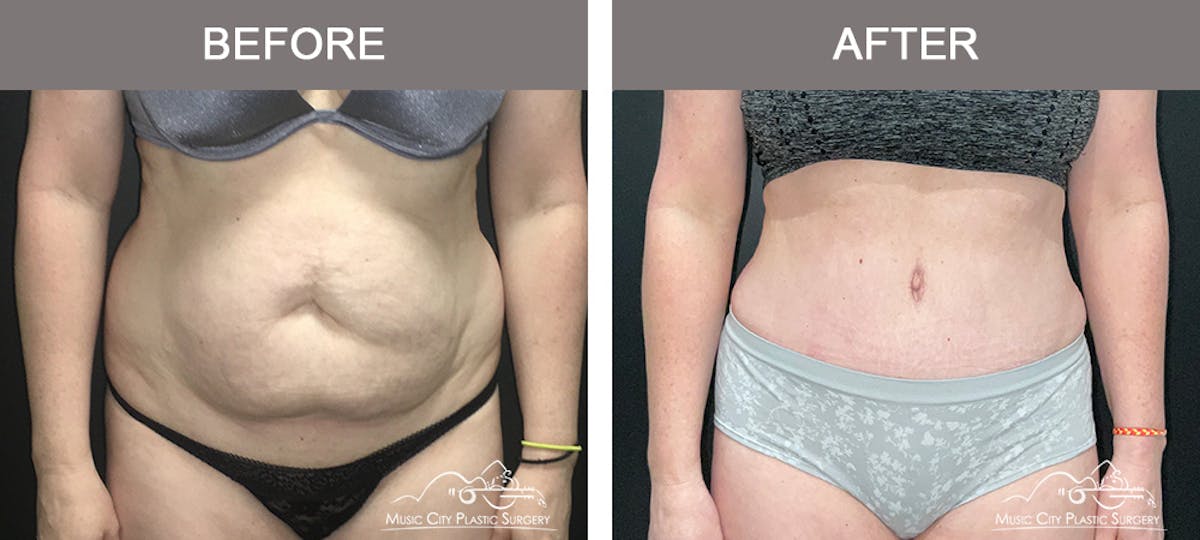 Abdominoplasty Before & After Gallery - Patient 200482 - Image 1