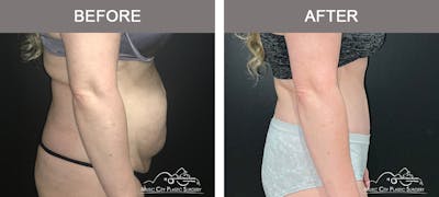 Abdominoplasty Before & After Gallery - Patient 200482 - Image 3