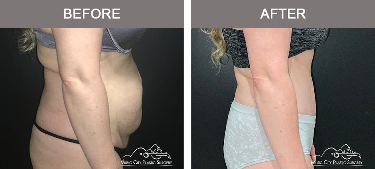 Abdominoplasty Before & After Gallery - Patient 200482 - Image 3
