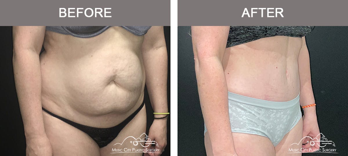 Abdominoplasty Before & After Gallery - Patient 200482 - Image 2