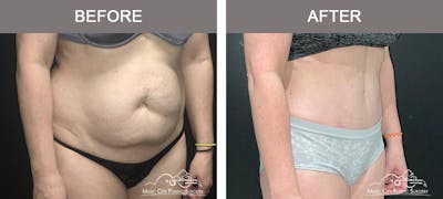 Abdominoplasty Before & After Gallery - Patient 200482 - Image 2