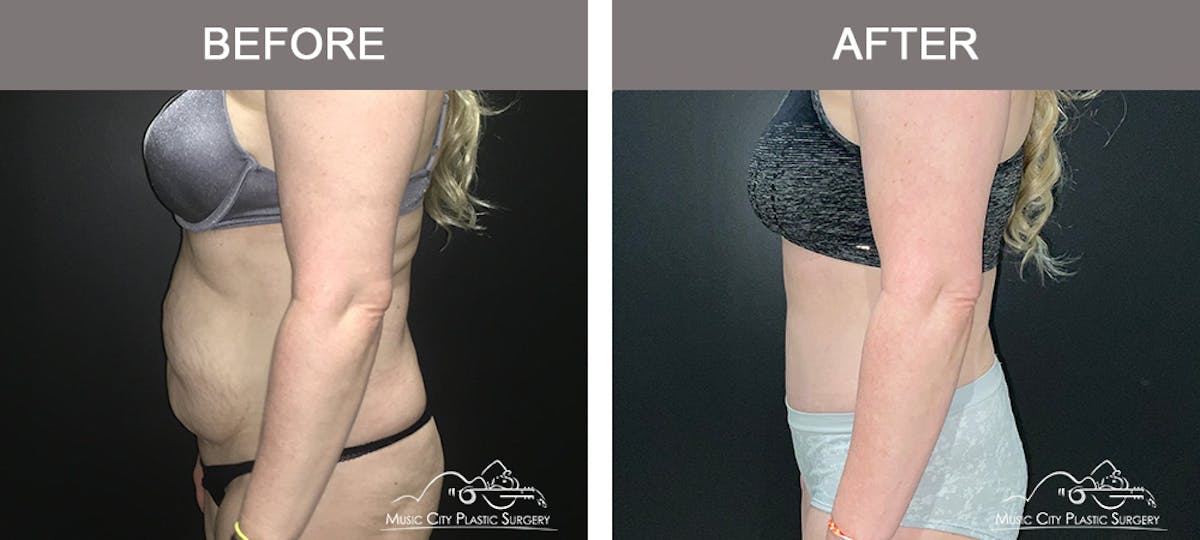 Abdominoplasty Before & After Gallery - Patient 200482 - Image 4