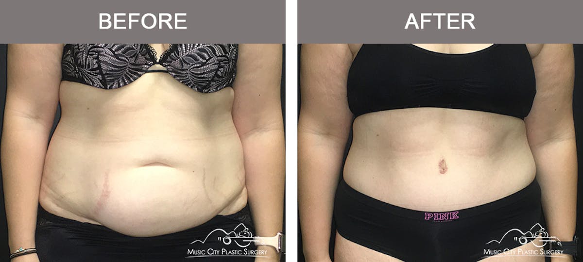 Abdominoplasty Before & After Gallery - Patient 400292 - Image 1