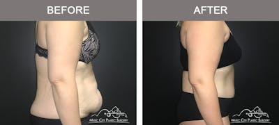 Abdominoplasty Before & After Gallery - Patient 400292 - Image 3