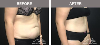 Abdominoplasty Before & After Gallery - Patient 400292 - Image 2