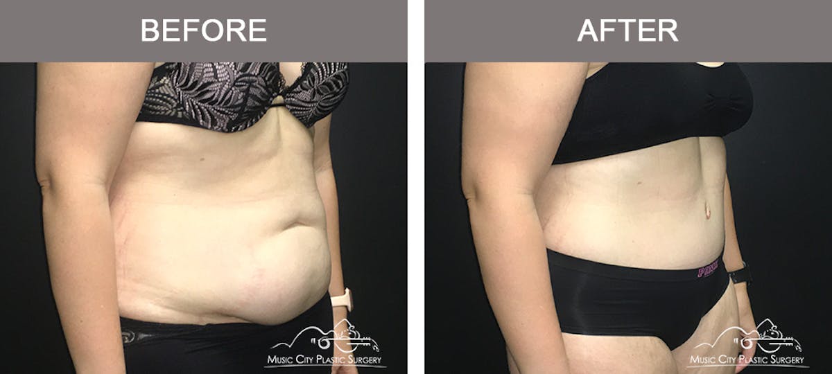 Abdominoplasty Before & After Gallery - Patient 400292 - Image 2