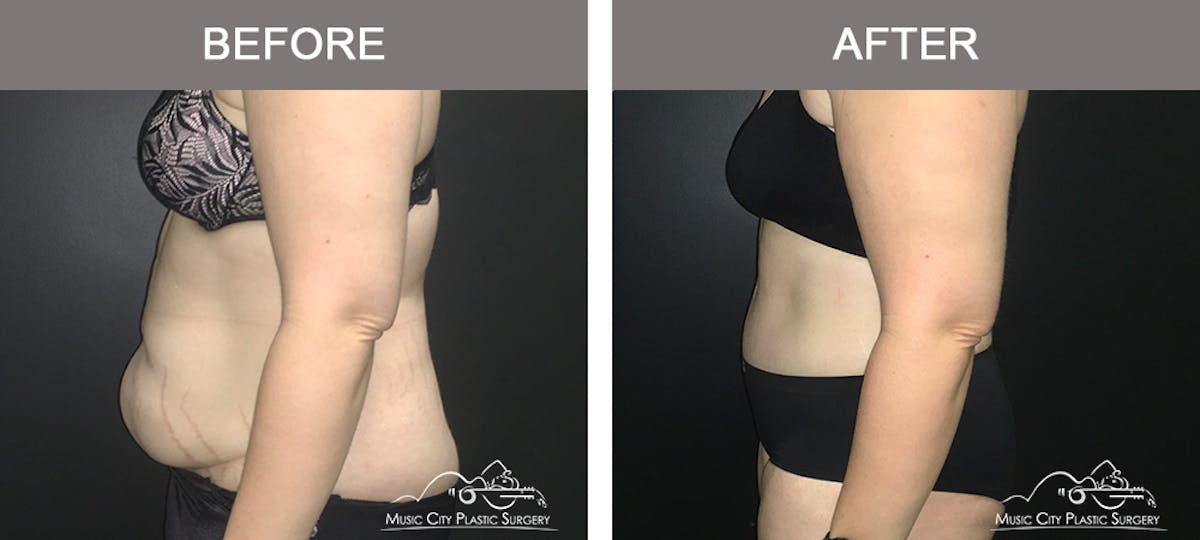 Abdominoplasty Before & After Gallery - Patient 400292 - Image 5