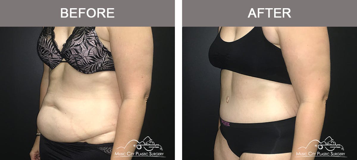 Abdominoplasty Before & After Gallery - Patient 400292 - Image 4