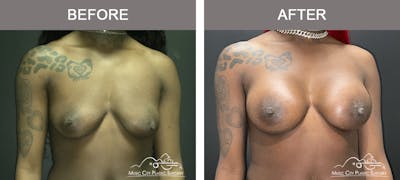 Breast Augmentation Before & After Gallery - Patient 380832 - Image 1