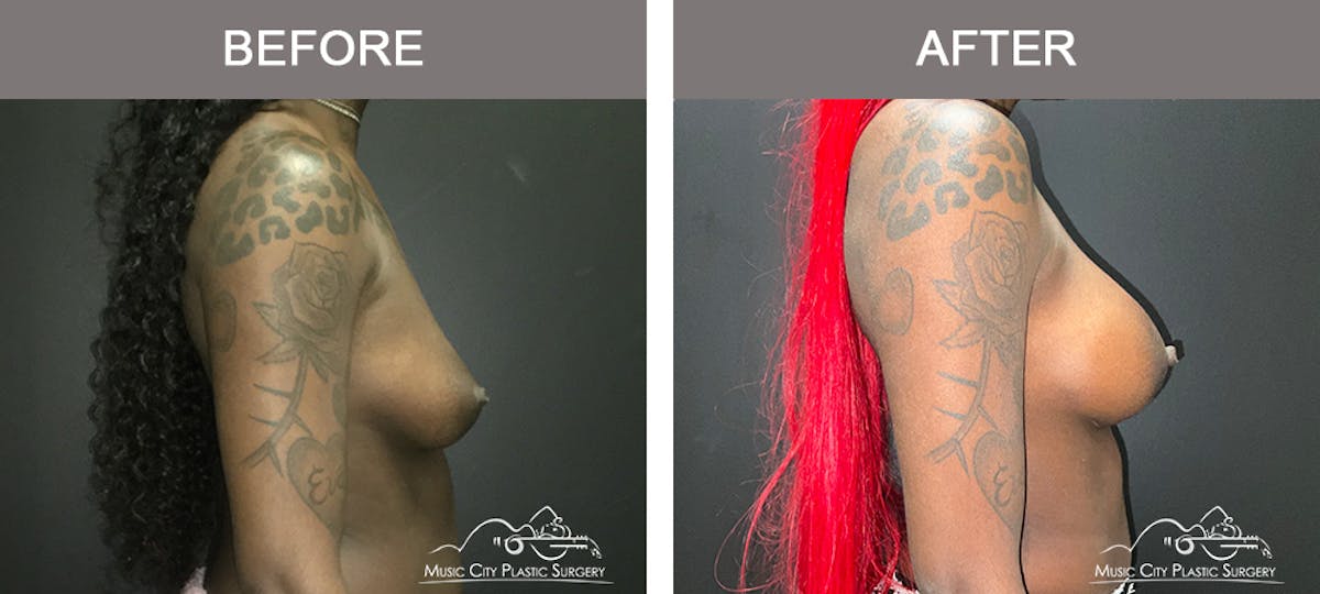 Breast Augmentation Before & After Gallery - Patient 380832 - Image 3