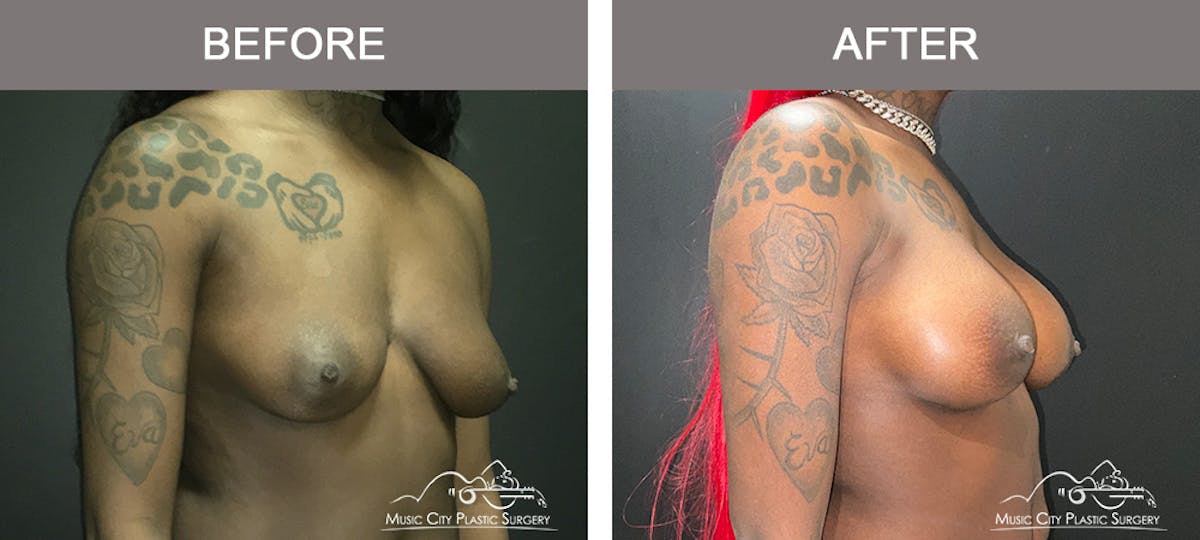 Breast Augmentation Before & After Gallery - Patient 380832 - Image 2