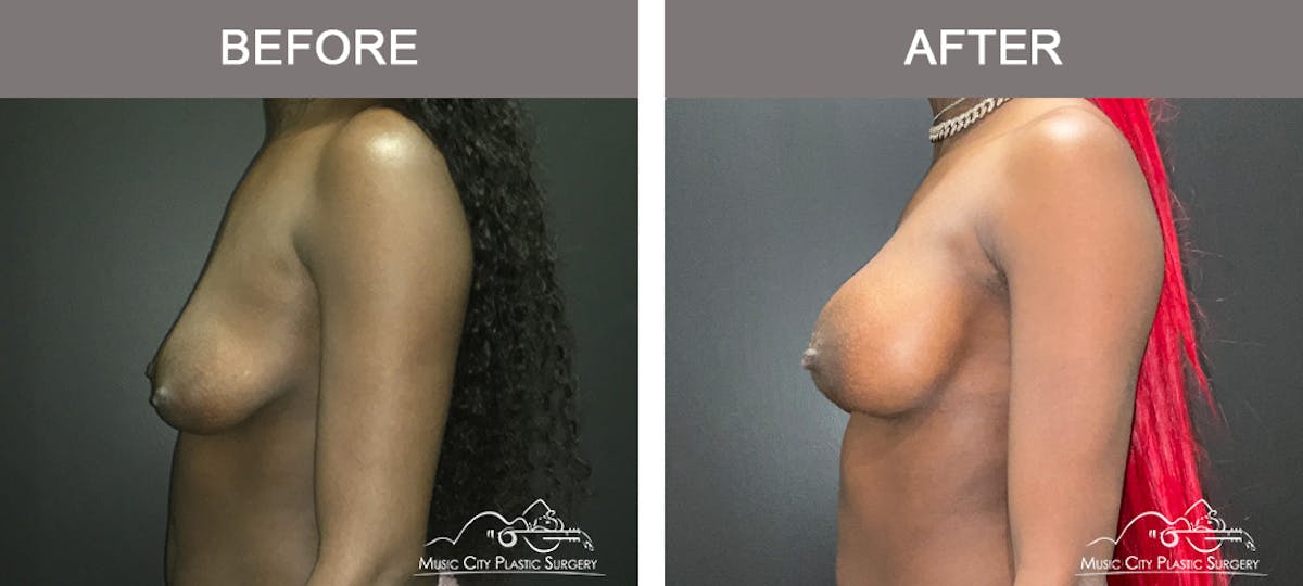 Breast Augmentation Before & After Gallery - Patient 380832 - Image 5