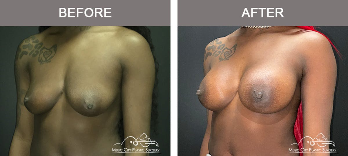 Breast Augmentation Before & After Gallery - Patient 380832 - Image 4