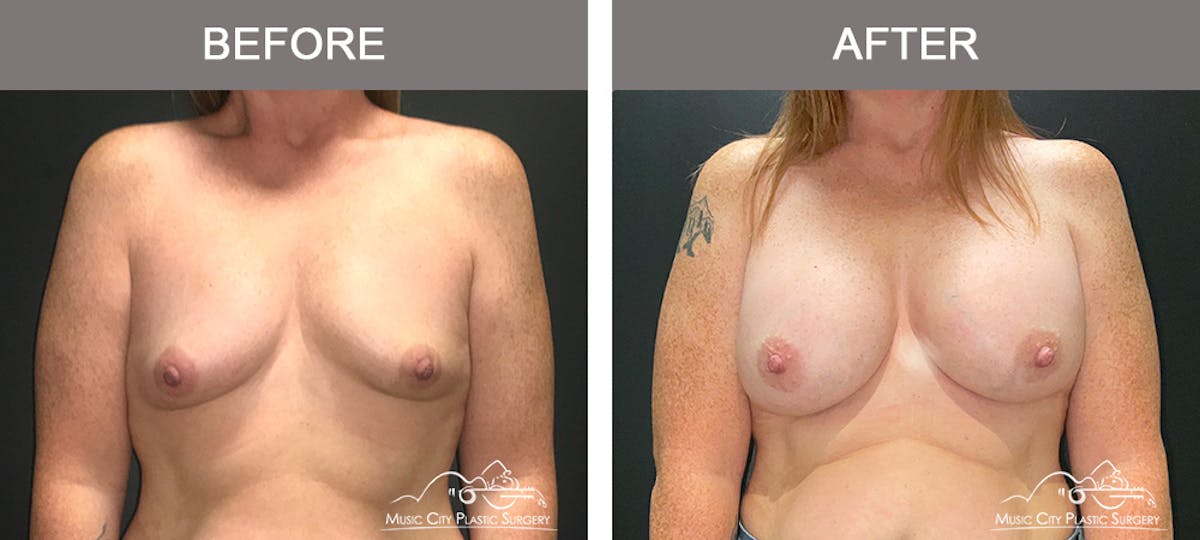 Breast Augmentation Before & After Gallery - Patient 216130 - Image 1