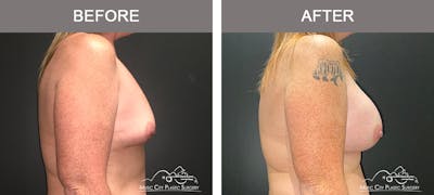 Breast Augmentation Before & After Gallery - Patient 216130 - Image 3