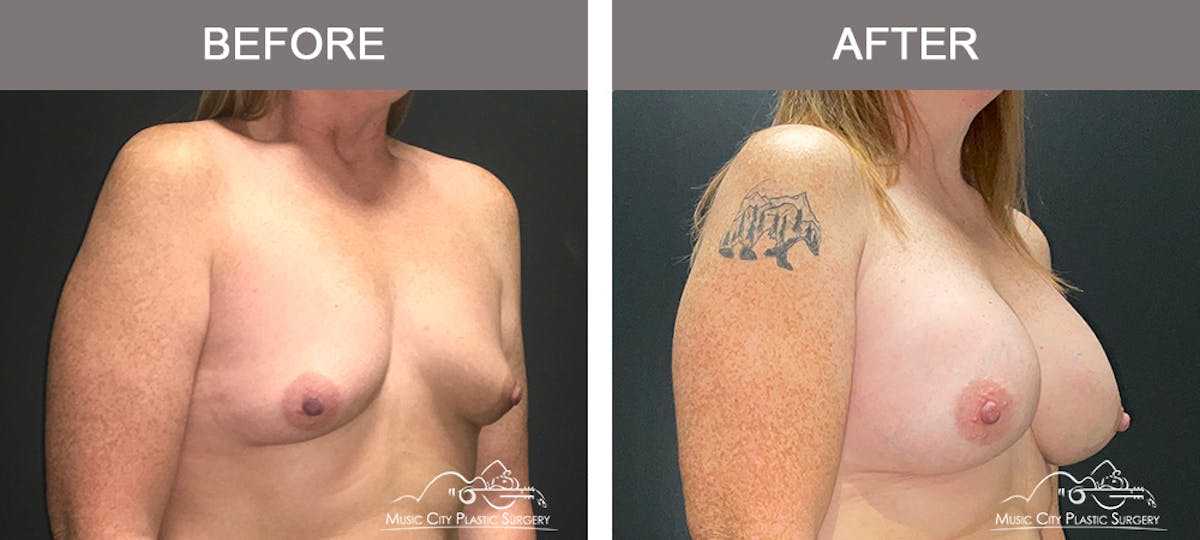 Breast Augmentation Before & After Gallery - Patient 216130 - Image 2