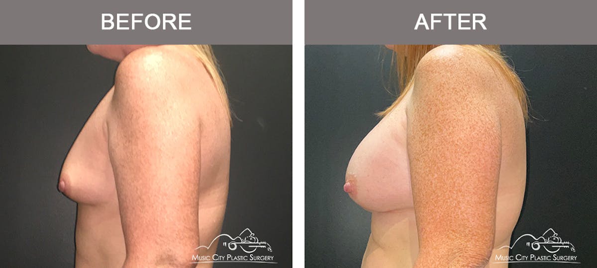 Breast Augmentation Before & After Gallery - Patient 216130 - Image 5