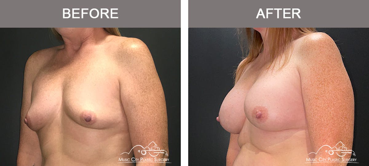Breast Augmentation Before & After Gallery - Patient 216130 - Image 4