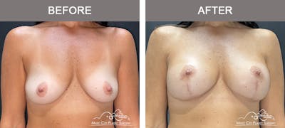 Breast Lift Before & After Gallery - Patient 303905 - Image 1