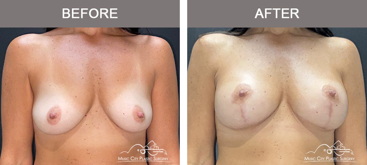 Breast Lift Before & After Gallery - Patient 303905 - Image 1