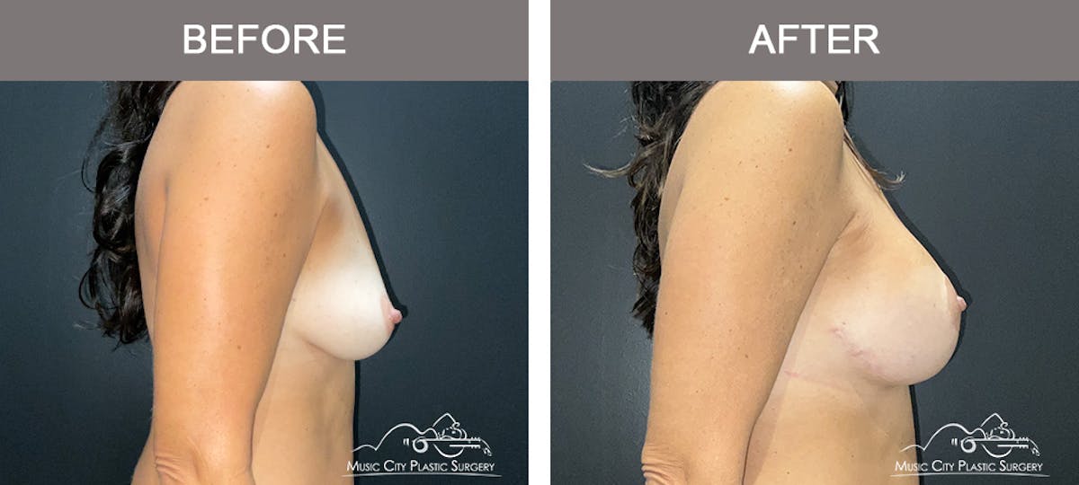 Breast Lift Before & After Gallery - Patient 303905 - Image 3