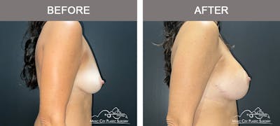 Breast Augmentation Before & After Gallery - Patient 319262 - Image 3
