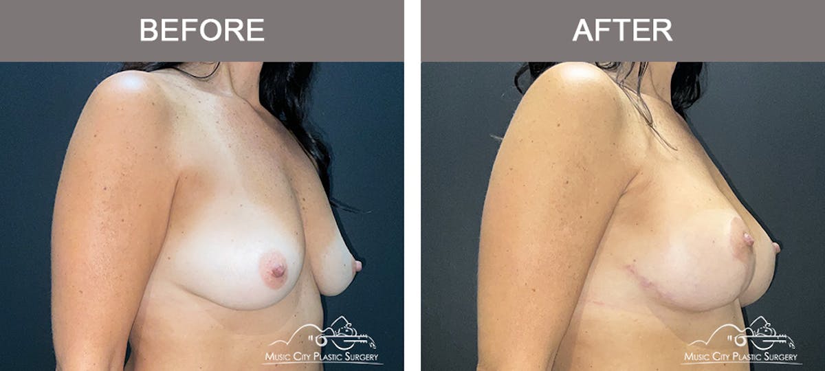 Breast Augmentation Before & After Gallery - Patient 319262 - Image 2