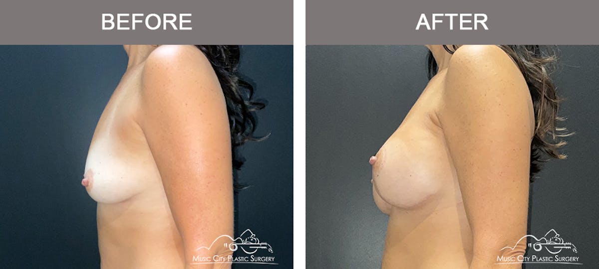 Breast Augmentation Before & After Gallery - Patient 319262 - Image 5