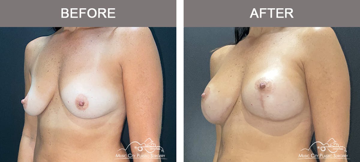 Breast Lift Before & After Gallery - Patient 303905 - Image 4