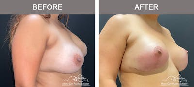 Implant Exchange Before & After Gallery - Patient 660951 - Image 2