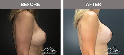 Implant Exchange Before & After Gallery - Patient 157182 - Image 3