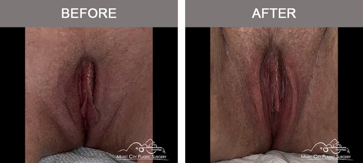 Labiaplasty Before & After Gallery - Patient 884570 - Image 1