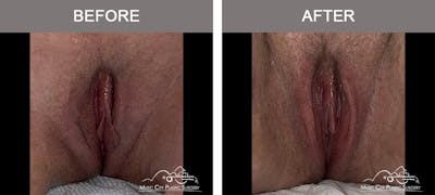 Labiaplasty Before & After Gallery - Patient 884570 - Image 1