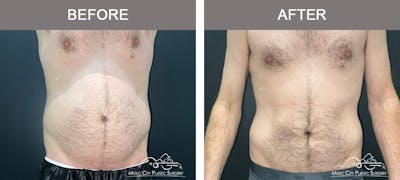 Male Liposuction Before & After Gallery - Patient 468244 - Image 1